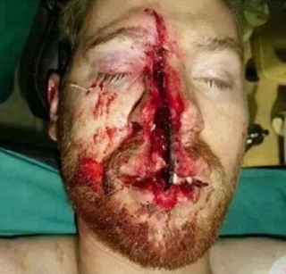 Cum arată capul actorului după accident