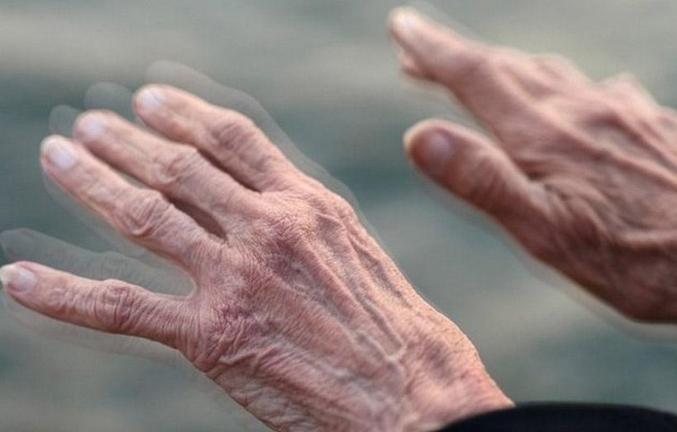 S-a descoperit o posibilă cauză pentru boala Parkinson! Primele semne pot apărea la zeci de ani de la expunere