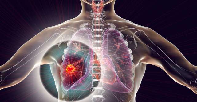 Cele mai multe cazuri de cancer pulmonar apar la persoanele care au fumat